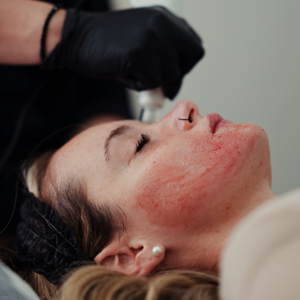 SkinPen® Microneedling